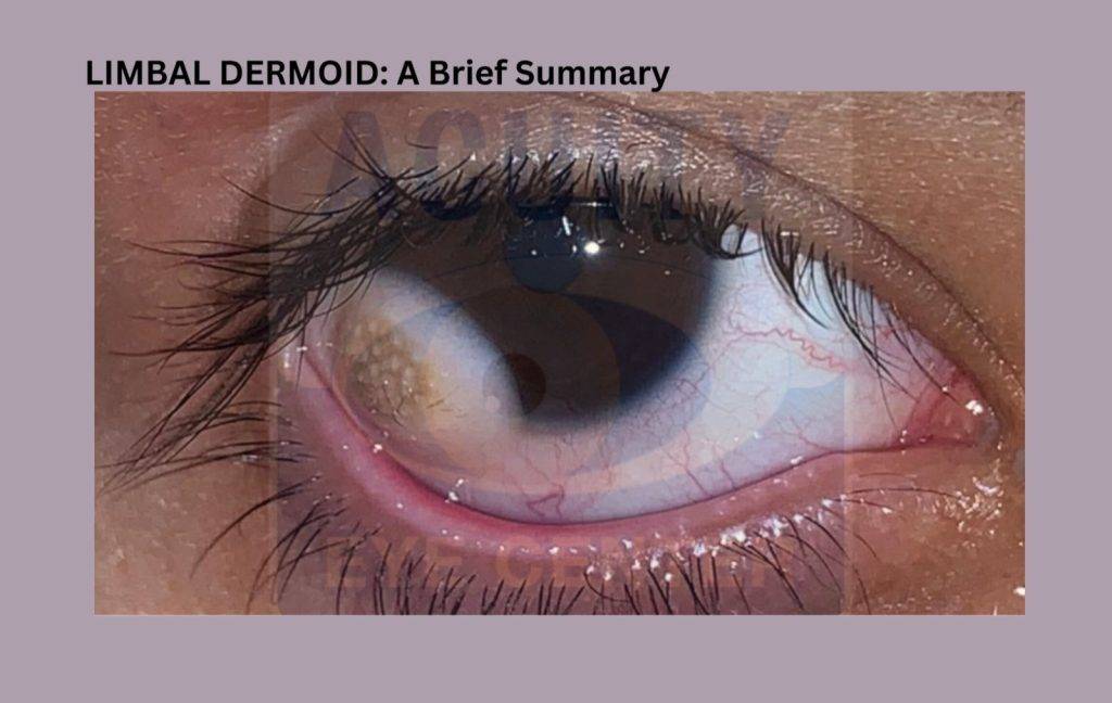 Limbal Dermoid cover